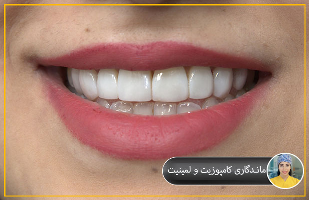 ماندگاری کامپوزیت و لمینیت