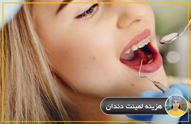 هزینه لمینت دندان